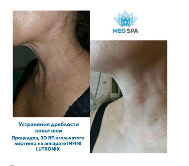 Игольчатый RF лифтинг lnfini